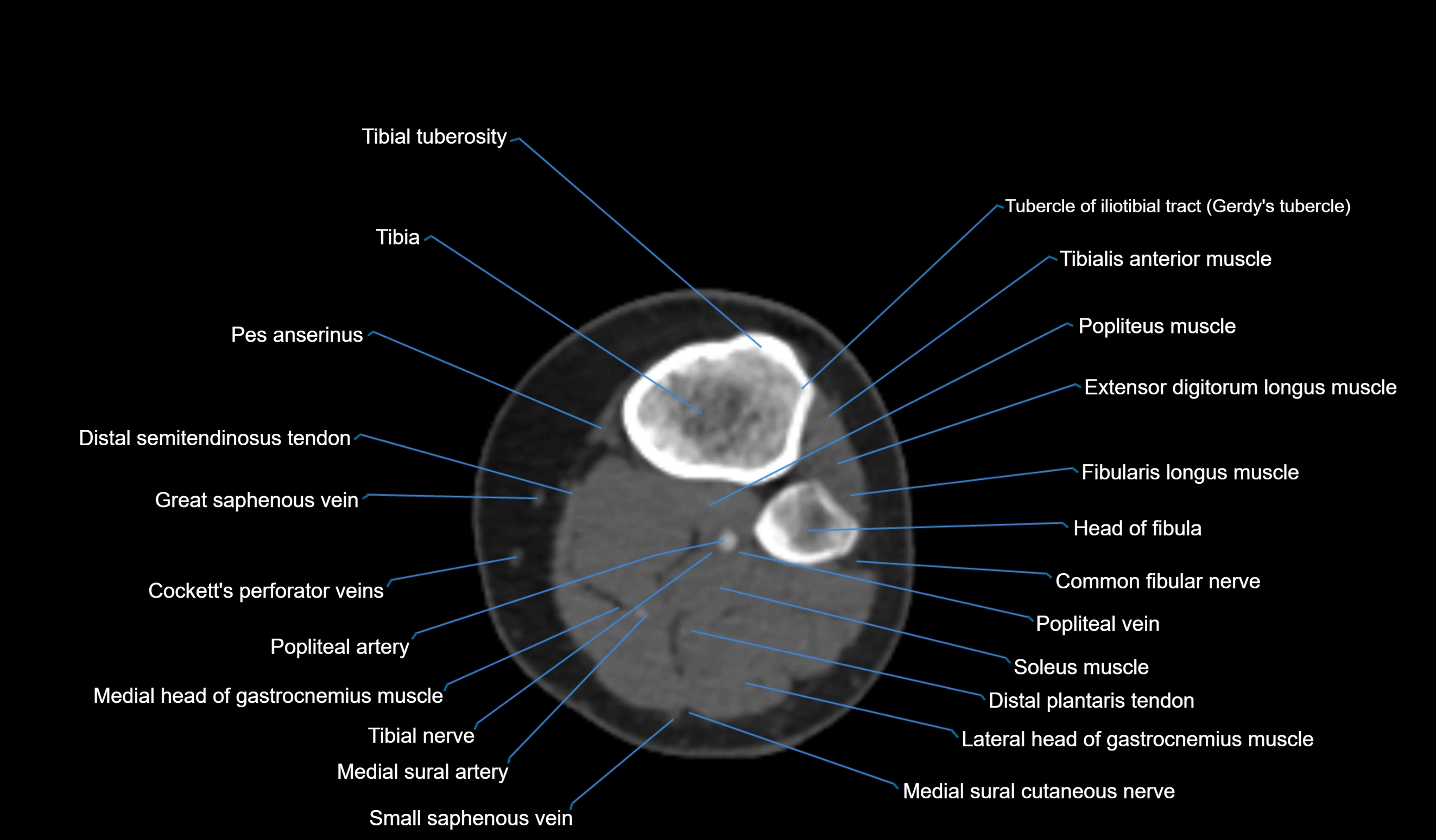 CT knee axial cross sectional anatomy labelled image-00048.webp